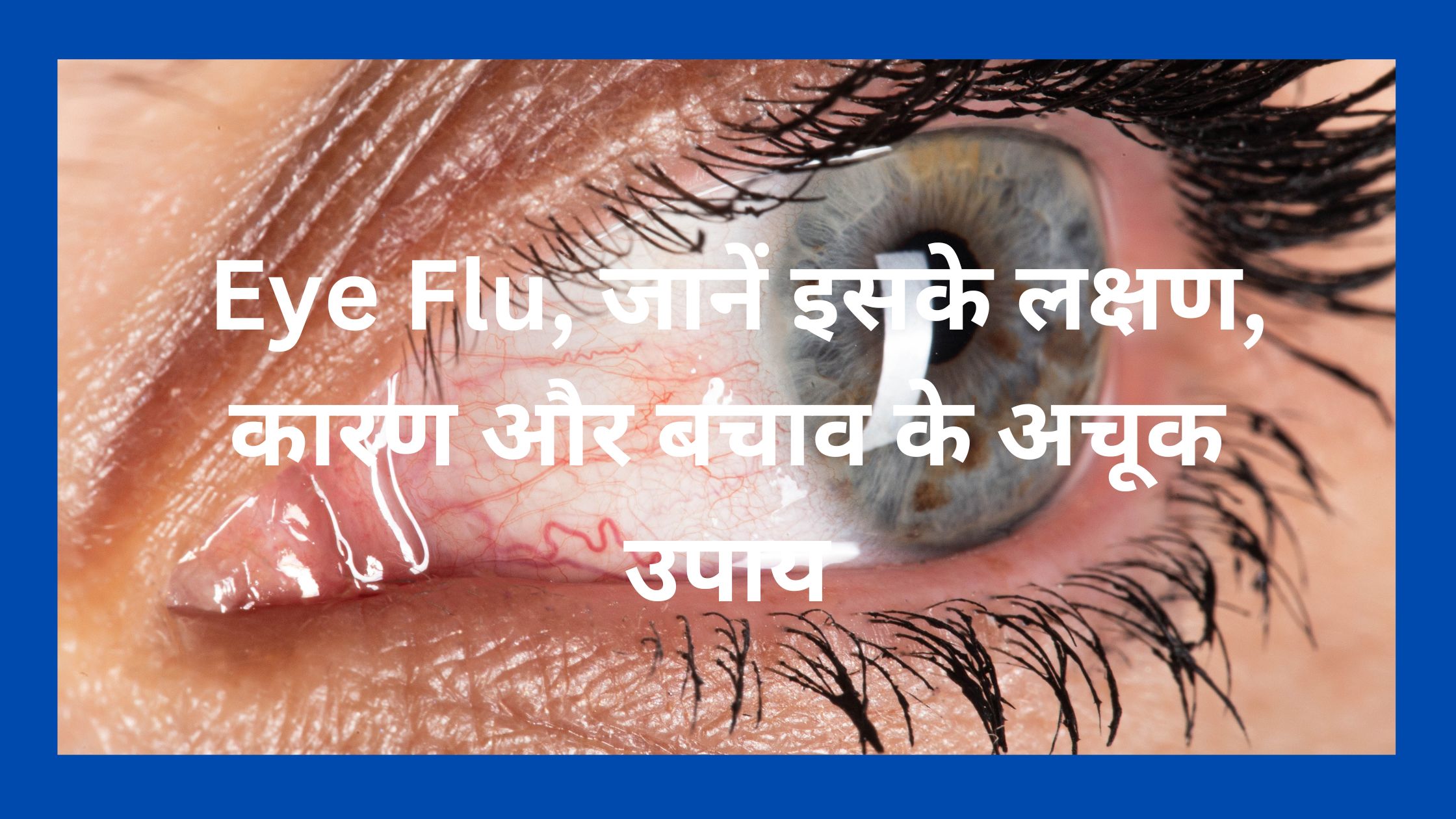 Eye Flu symptoms, कारण और बचाव के अचूक उपाय